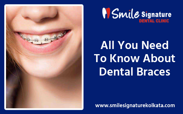 All You Need To Know About Dental Braces