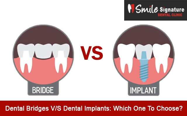 Dental Bridges V/S Dental Implants: Which One To Choose?