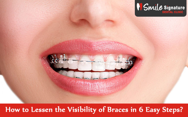 How to Lessen the Visibility of Braces in 6 Easy Steps?