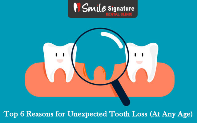 Top 6 Reasons for Unexpected Tooth Loss (At Any Age)