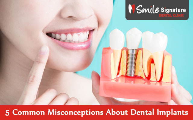 5 Common Misconceptions About Dental Implants: Separating Facts from Myths